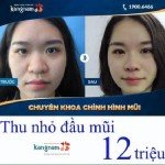 Chi phí thu gọn đầu mũi giá bao nhiêu? Đ/C Thu nhỏ đầu mũi ở đâu đẹp?