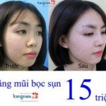 Nâng mũi bọc sụn giá bao nhiêu tại Kangnam?