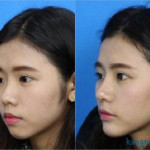 Nâng mũi L Line hay S Line đẹp Hơn? Bạn phù hợp với dáng mũi nào?