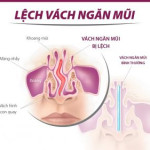 Lệch vách ngăn mũi: Nguyên nhân, Biểu hiện và Cách điều trị