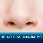 Đầu mũi to sau khi nâng mũi | Nguyên nhân và cách khắc phục hiệu quả