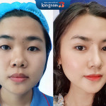 Nâng mũi Sline cấu trúc là gì? Ưu,nhược điểm ra sao?