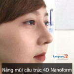 Nâng mũi cấu trúc 4D NanoForm – Sự khác biệt đến từ công nghệ