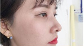 Nâng Mũi Hàn Quốc là gì? Chi phí bao nhiêu tiền? Có tốt không?