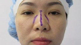 Sửa mũi có phá tướng không? Nâng mũi đổi vận Cát Tướng thế nào?