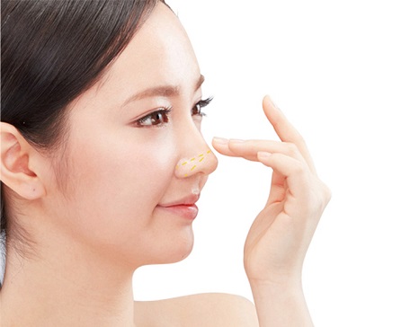 Nâng mũi cấu trúc 4D tự thân là gì? Phù hợp với những ai?