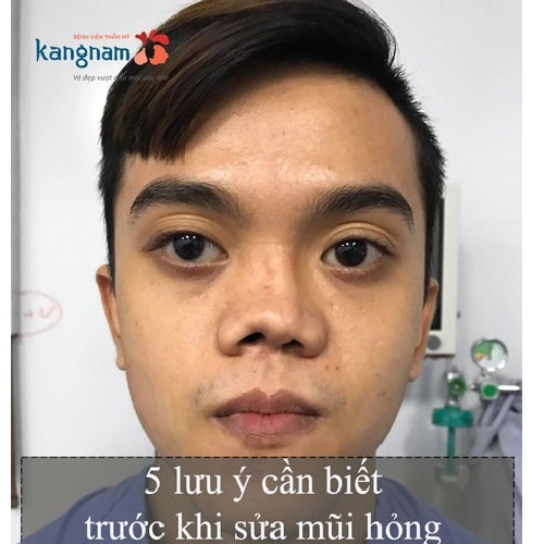 (Nâng)Sửa mũi hỏng là như thế nào? Cách khắc phục khi (sửa) nâng mũi bị hỏng