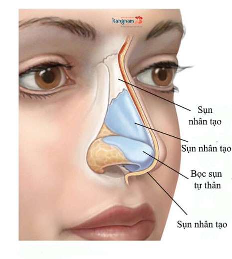 Phẫu thuật nâng mũi bọc sụn vành tai