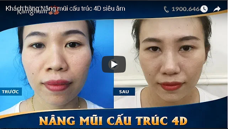 video khách hàng nâng mũi cấu trúc 4d siêu âm