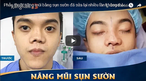 video khách hàng nâng mũi cấu trúc 4D siêu âm