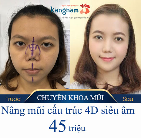 Nâng mũi cấu trúc 4D siêu âm giá bao nhiêu