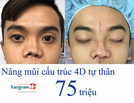 Nâng mũi cấu trúc 4D tự thân giá bao nhiêu tiền?