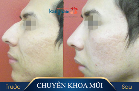 Chỉnh sửa mũi gồ bằng sụn tự thân