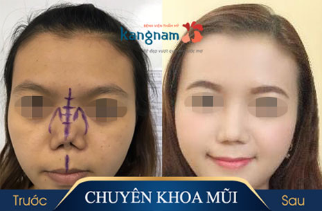 Mũi hỏng do thẩm mỹ