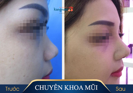 Sửa mũi tẹt bằng sụn tự thân