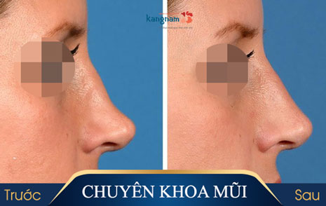 Nâng mũi tự thân chỉnh hình mọi dáng mũi