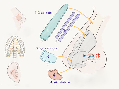 Nâng mũi cấu trúc 4D tự thân