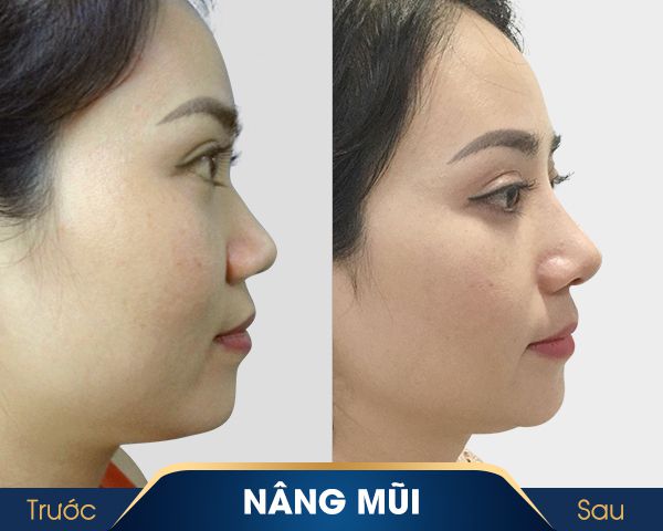 dịch vụ nâng mũi hàn quốc ở kangnam