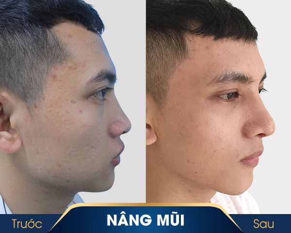 trước và sau khi nâng sống mũi