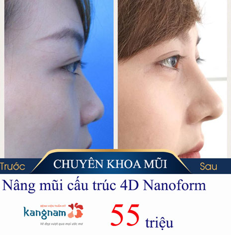 nâng mũi cấu trúc 4D nanoform giá bao nhiêu