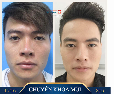 sửa mũi cấu trúc