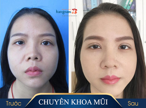 phẫu thuật nâng mũi cấu trúc 4D nanoform