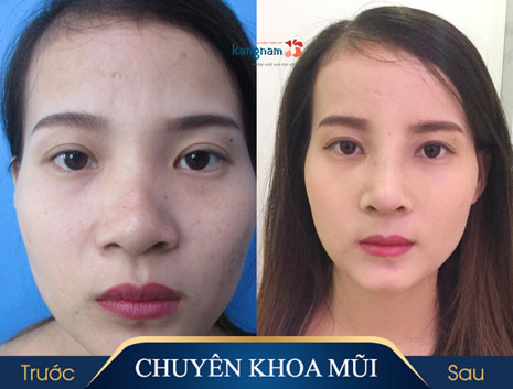 nâng mũi cấu trúc