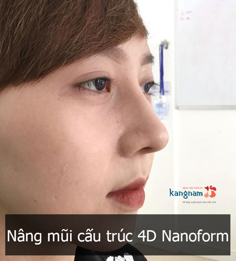 Nâng mũi cấu trúc 4D NanoForm – Sự khác biệt đến từ công nghệ