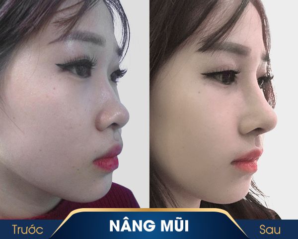 nâng mũi tại kangnam nên hay không