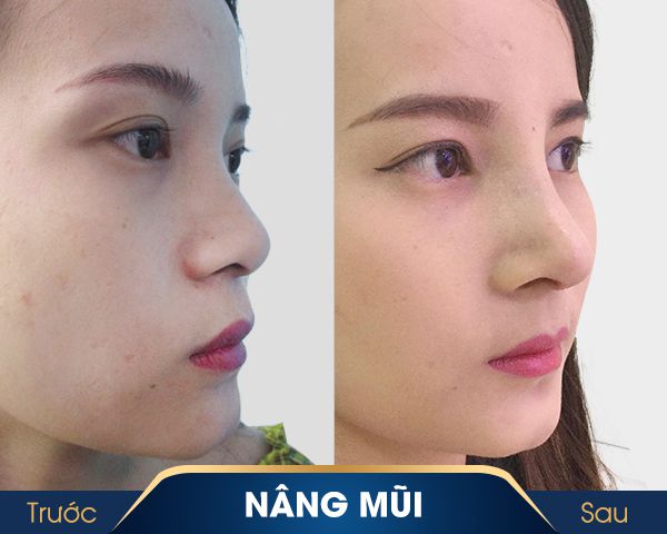 trước và sau khi sử dụng dịch vụ nâng mũi kangnam