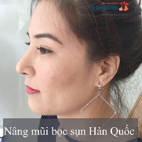 Nâng mũi bọc sụn là gì? Có vĩnh viễn không? Làm ở đâu Đẹp tại Hà Nội, TpHCM