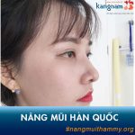 Nâng Mũi Hàn Quốc là gì? Chi phí bao nhiêu tiền? Có tốt không?