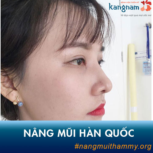 Nâng Mũi Hàn Quốc là gì? Chi phí bao nhiêu tiền? Có tốt không?