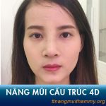 Sửa/Nâng mũi cấu trúc 4D là gì? Nâng mũi cấu trúc có vĩnh viễn không?