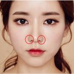 Thu gọn cánh mũi nội soi là gì? Bạn nên cắt cánh mũi hay cuộn cánh mũi?