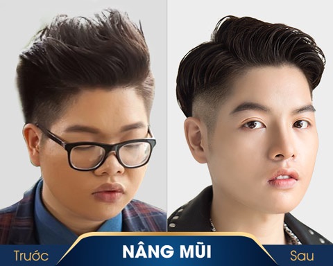 đức phúc trước và sau khi nâng mũi