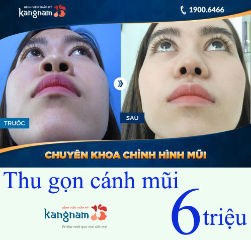 Thu gọn cánh mũi bao nhiêu tiền? Giá tại Kangnam