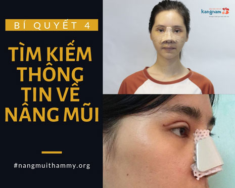 nâng mũi cấu trúc