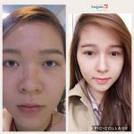 Nâng mũi bao lâu thì đẹp? Có được vĩnh viễn không?