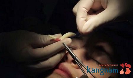 nâng mũi tại viện 108