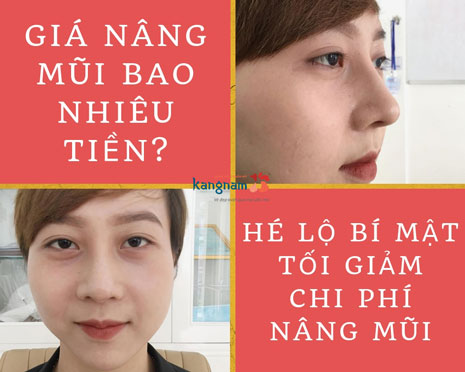 nâng mũi giá bao nhiêu