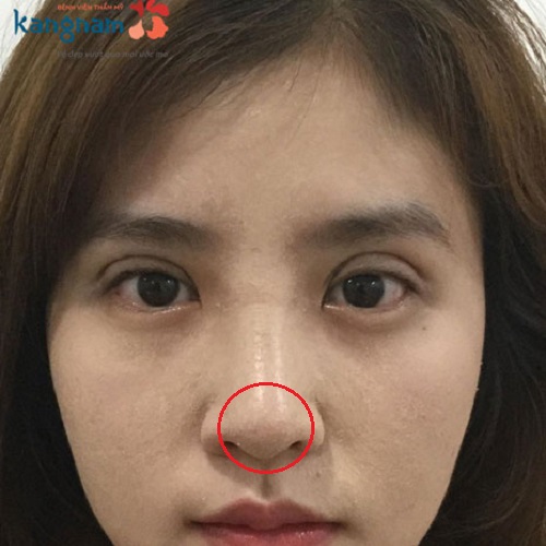 Phẫu thuật thu nhỏ đầu mũi nội soi là gì? Có nên thu gọn đầu mũi không?