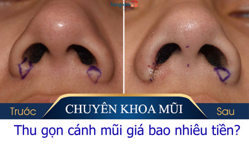 giá phẫu thuật thu gọn cánh mũi bao nhiêu tiền