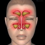 Lỗ mũi có mùi hôi là bệnh gì? Cách chữa mũi có mùi hôi tanh hiệu quả