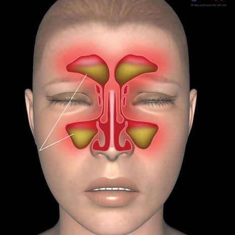 Lỗ mũi có mùi hôi là bệnh gì? Cách chữa mũi có mùi hôi tanh hiệu quả