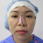 Mũi hếch là gì? Mũi hếch tướng số như thế nào? Cách chữa mũi bị hếch tốt nhất