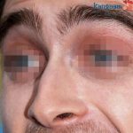 Mũi Diều Hâu (Khoằm, Két, Chim Ưng, Quặp) theo Tướng số Xấu hay Đẹp? Có nên sửa không?