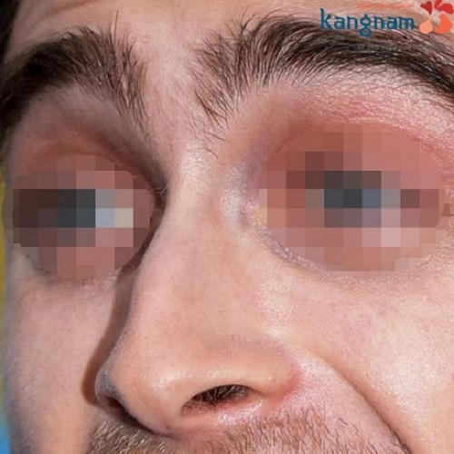 Mũi Diều Hâu (Khoằm, Két, Chim Ưng, Quặp) theo Tướng số Xấu hay Đẹp? Có nên sửa không?