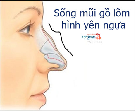 sống mũi gồ tướng số