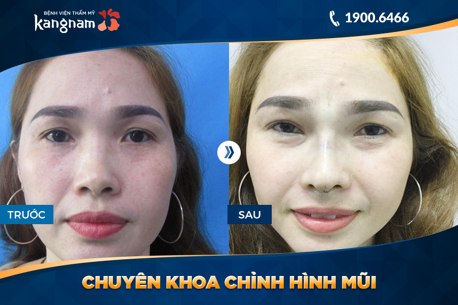 kết quả sửa mũi hếch